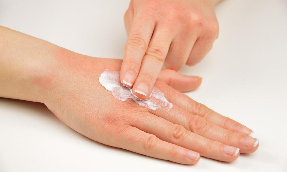 liječenje psorijaze kremom Keramin
