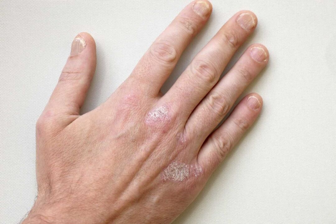 liječenje psorijaze na rukama muškarca kremom Keramin