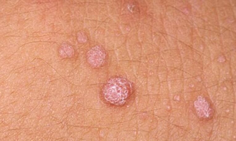 HPV dovodi do pojave papiloma na koži