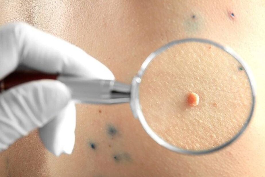 HPV liječenje