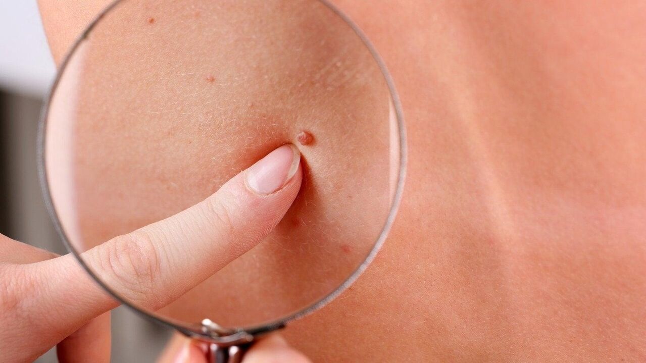 papiloma u aksilarnom području